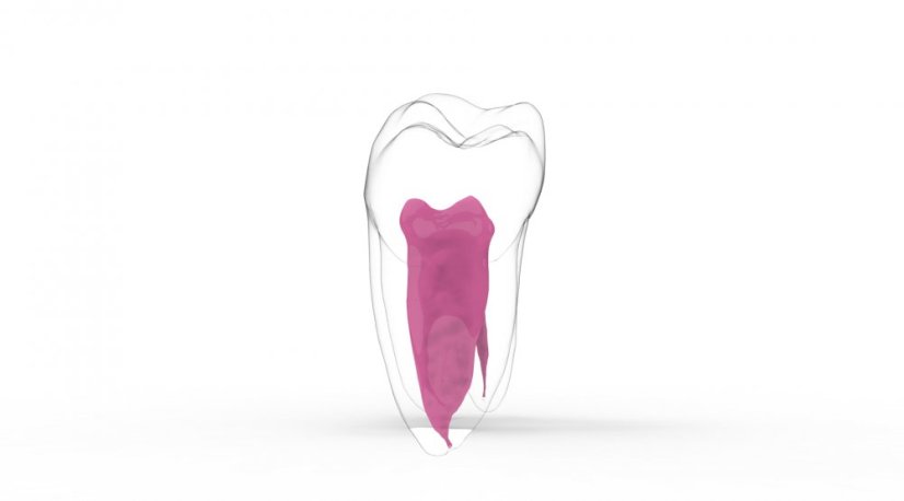 EndoTooth 37 Lower Molar (More Complex)