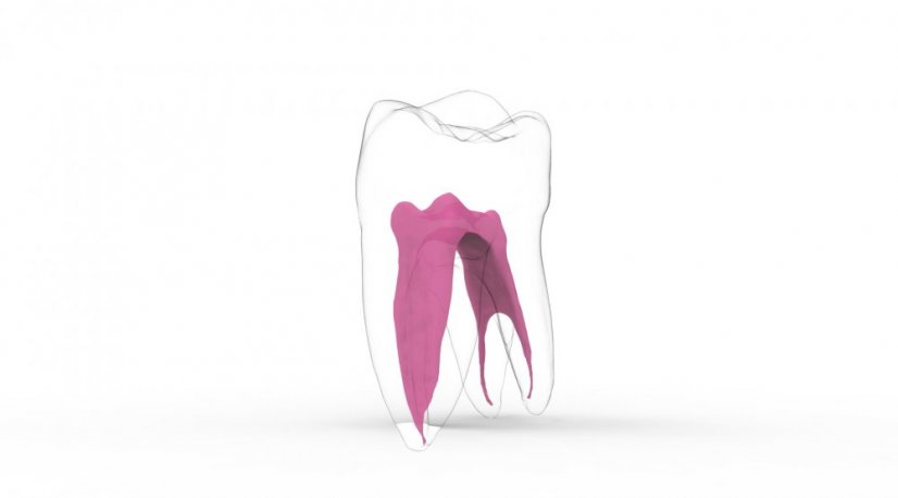 EndoTooth 37 Lower Molar (More Complex) - Acceso al diente: Accedido, Pulpa dentaria: Sin tejido pulpar