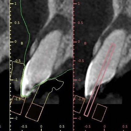 Endodontic Guide