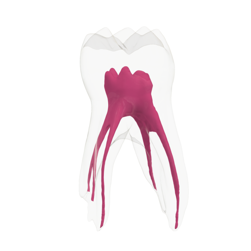EndoTooth 84 Deciduous Lower Molar - Transparencia: Opaco, Acceso al diente: Accedido, Pulpa dental: Con pulpa