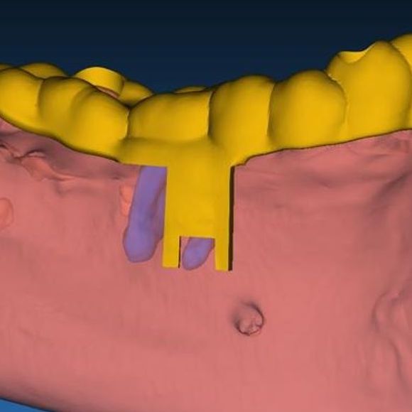 Apical Resection Guide