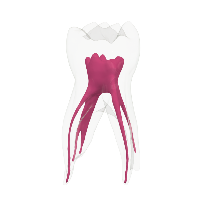 EndoTooth 84 Deciduous Lower Molar - Transparencia: Opaco, Acceso al diente: Accedido, Pulpa dental: Con pulpa