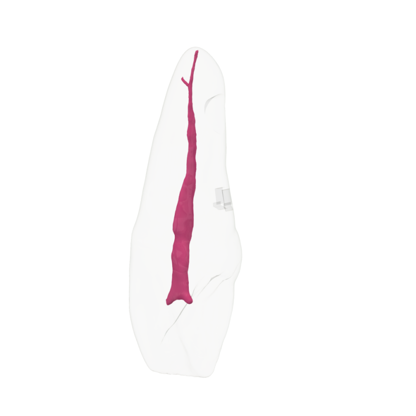 EndoTooth 11 Upper Incisor - (Biovoxel Typodont) - Durchsichtigkeit: Übersichtlich, Zugriff auf den Zahn: Zugegriffen, Zahnmark: Ohne Fruchtfleisch