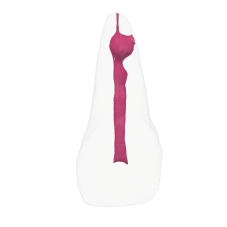 EndoTooth 21 Internal Resorption
