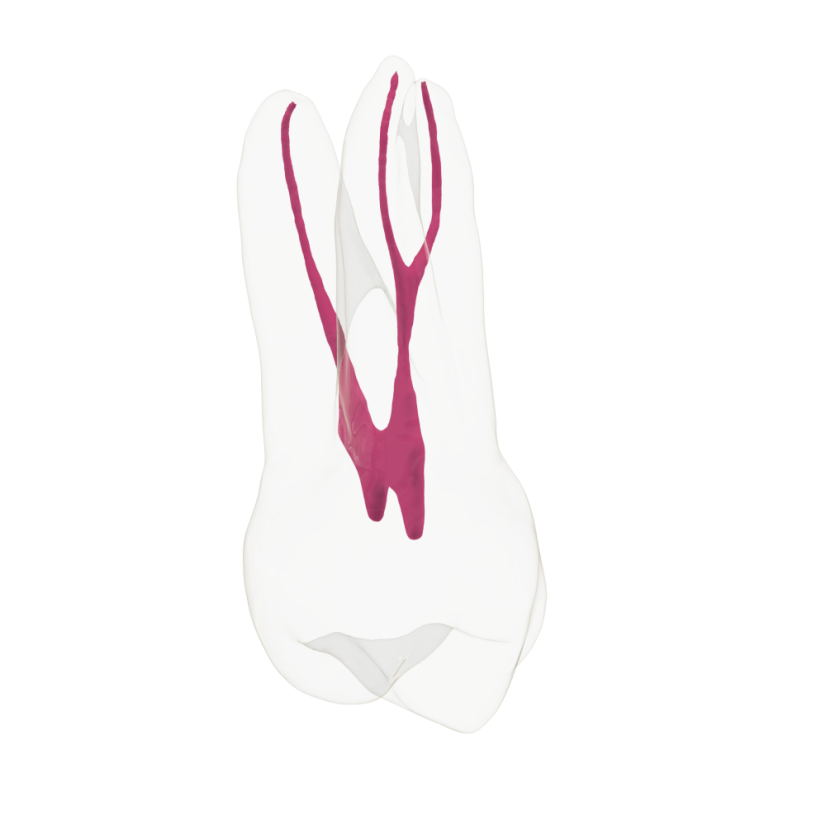 EndoTooth 14 Upper Premolar - Priehladnosť: Priehľadný, Trepanácia: Trepanovaný, Zubná dreň: Bez drene