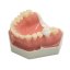 CariesTooth 16 (P-Oclusal)