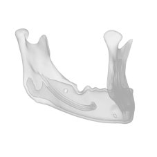 Augmentation + Implant Mandible Model