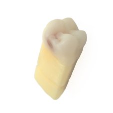 CariesTooth 16 (P-Occlusal)