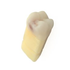CariesTooth 16 (P-Occlusal)