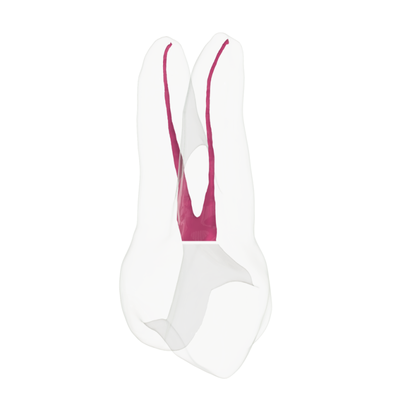 EndoTooth 14 Upper Premolar (Mesio-Occlusal access) - Transparencia: Transparente, Pulpa dental: Sin pulpa