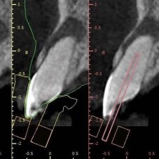 Endodontická šablóna