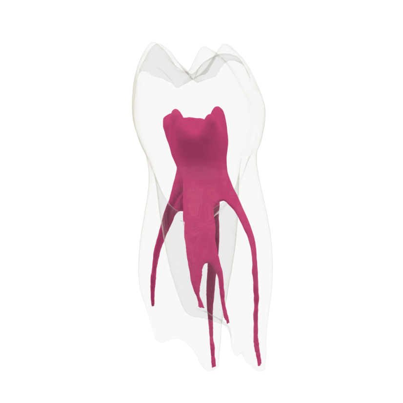 EndoTooth 84 Deciduous Lower Molar - Transparencia: Opaco, Acceso al diente: Accedido, Pulpa dental: Con pulpa