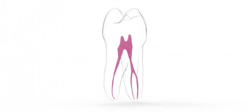 EndoTooth 14 Upper Premolar - Tooth Access: Accessed, Pulp: Without pulpal tissue