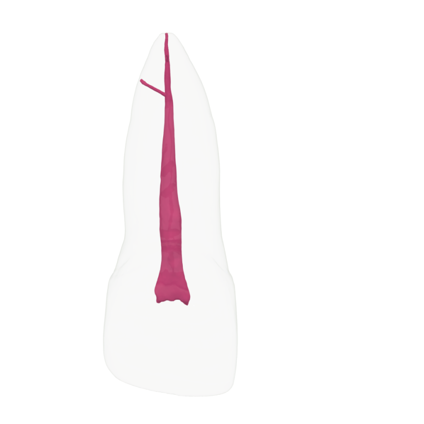 EndoTooth 11 Upper Incisor - Transparencia: Transparente, Acceso al diente: Accedido, Pulpa dental: Con pulpa