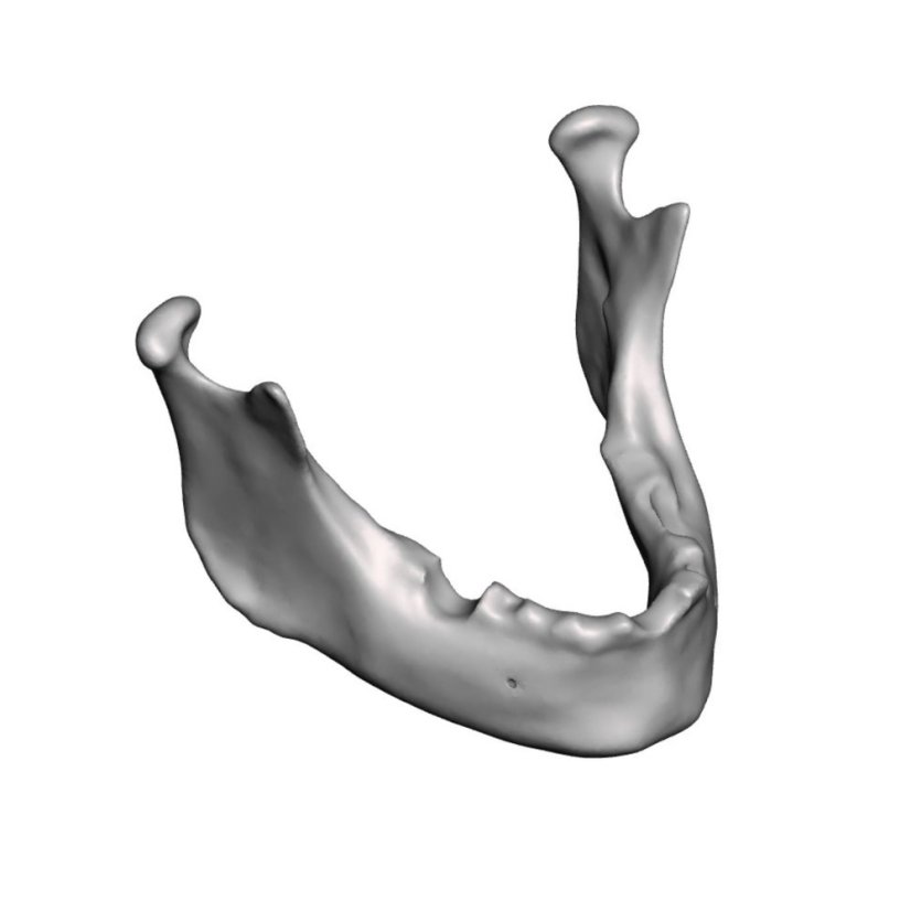 Augmentation + Implant Mandible Model