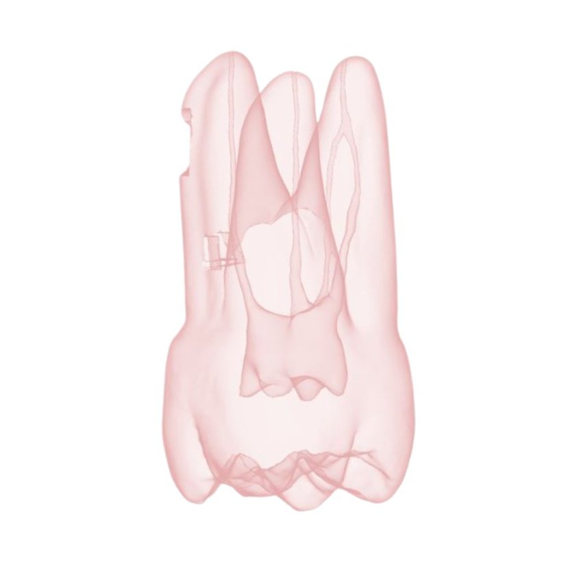 Endotooth 17 Upper Molar (Biovoxel Typodont) - Transparency: Transparent, Tooth Access: Accessed, Pulp: Without the pulp
