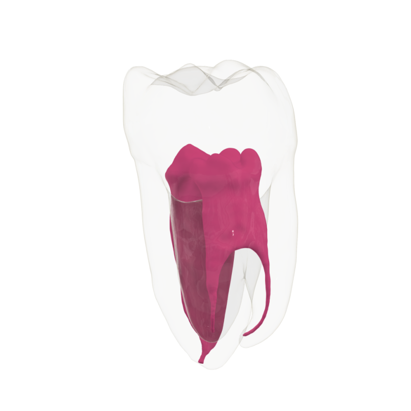 EndoTooth 37 Lower Molar (More Complex)
