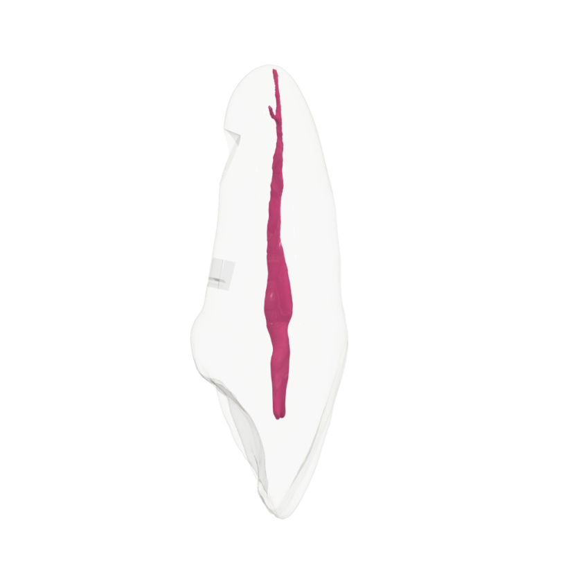 EndoTooth 11 Upper Incisor - (Biovoxel Typodont) - Durchsichtigkeit: Übersichtlich, Zugriff auf den Zahn: Zugegriffen, Zahnmark: Ohne Fruchtfleisch