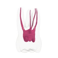 EndoTooth 16 Upper Molar (Less Complex)