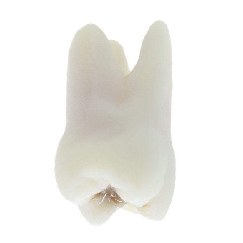 Opaque Endotooth 16 with Occlusal Caries (Biovoxel Typodont)