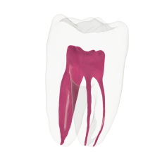EndoTooth 36 Lower Molar (Less Complex)