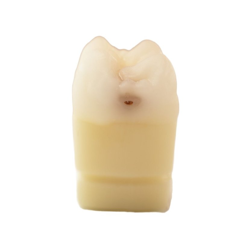 CariesTooth 16 (P-Oclusal)