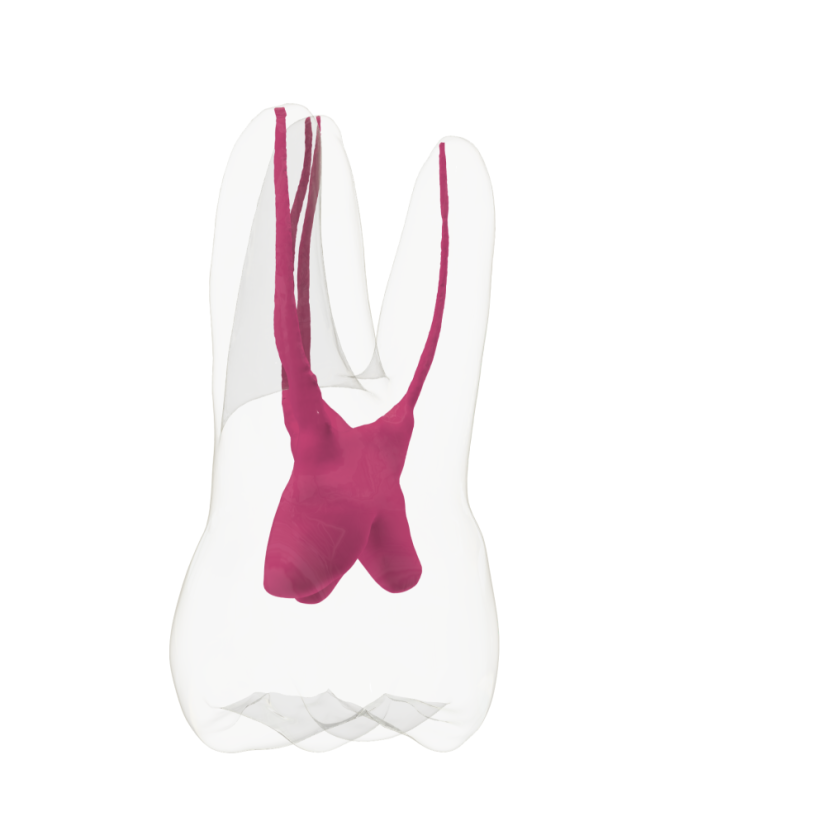 EndoTooth 16 Upper Molar (Less Complex) - Priehladnosť: Nepriehladný, Trepanácia: Trepanovaný, Zubná dreň: Bez drene