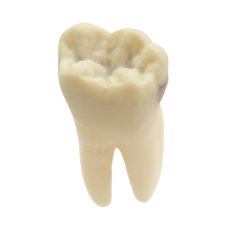 CariesTooth 46 (Biovoxel Typodont)