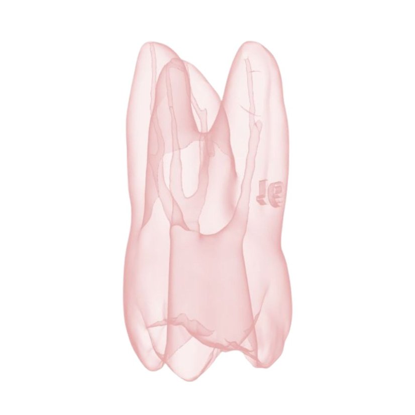 EndoTooth 16 Ledge Formation (Less Complex)