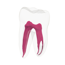 EndoTooth 37 Lower Molar (More Complex)