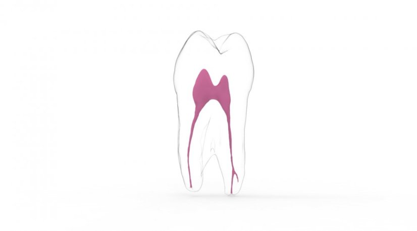 EndoTooth 24 Upper Premolar - Trepanácia: Intaktný, netrepanovaný, Zubná dreň: S dreňou