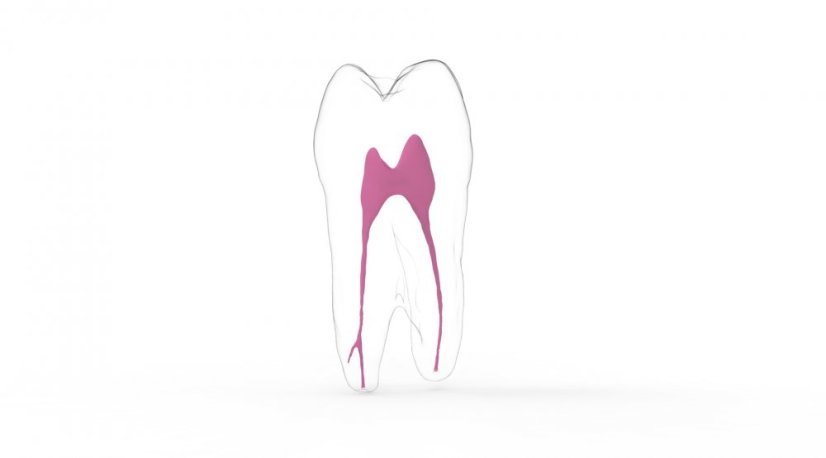 EndoTooth 24 Upper Premolar - Acceso al diente: Intacto, no accedido, Pulpa dentaria: Con tejido pulpar