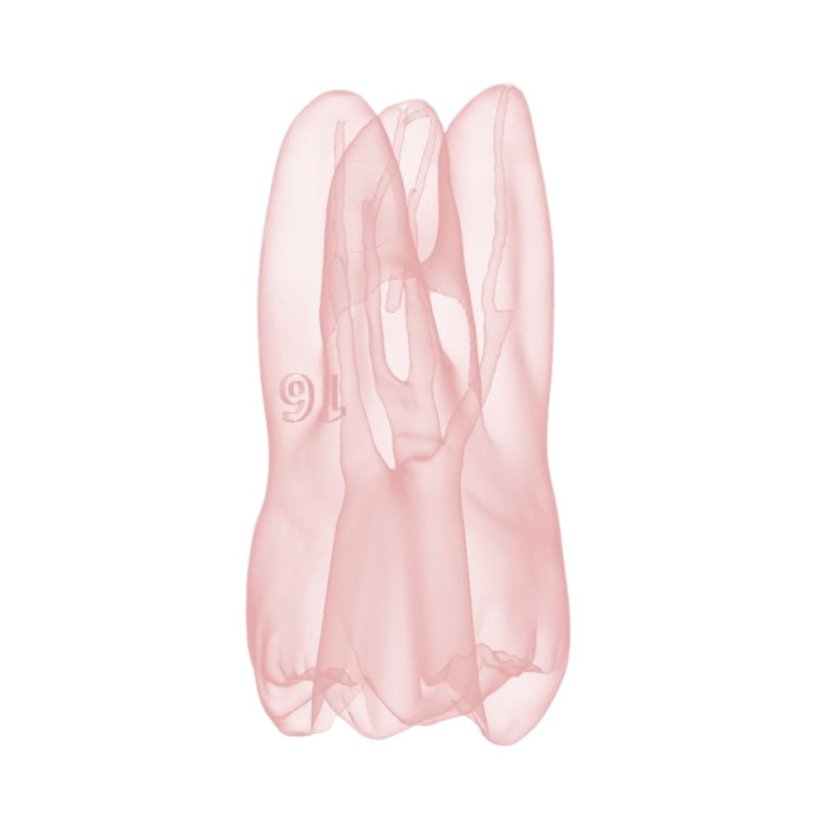 EndoTooth 16 Ledge Formation (Less Complex)