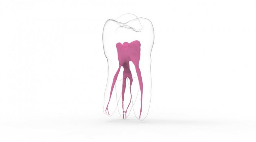 EndoTooth 16 Upper Molar (More Complex) - Durchsichtigkeit: Übersichtlich, Zugriff auf den Zahn: Zugegriffen, Zahnpulpa: Mit Pulpagewebe