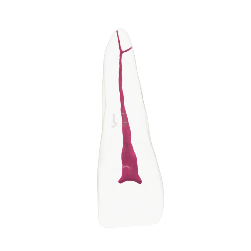 EndoTooth 11 Upper Incisor - (Biovoxel Typodont) - Durchsichtigkeit: Übersichtlich, Zugriff auf den Zahn: Zugegriffen, Zahnmark: Ohne Fruchtfleisch