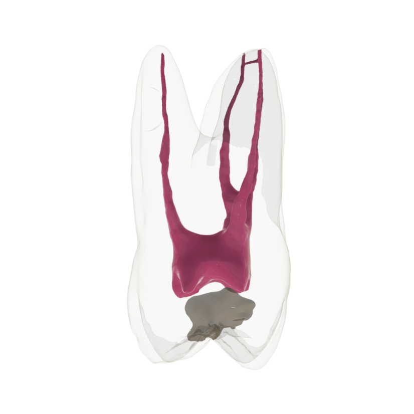 Opaque Endotooth 16 with Occlusal Caries (Biovoxel Typodont)