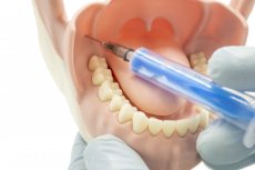 Mandibular Anesthesia Model