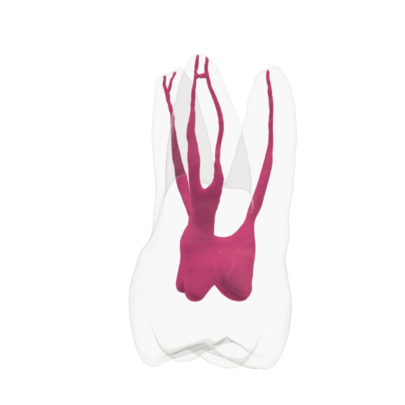 EndoTooth 16 Upper Molar (More Complex)
