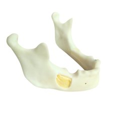 Augmentation + Implant Mandible Model