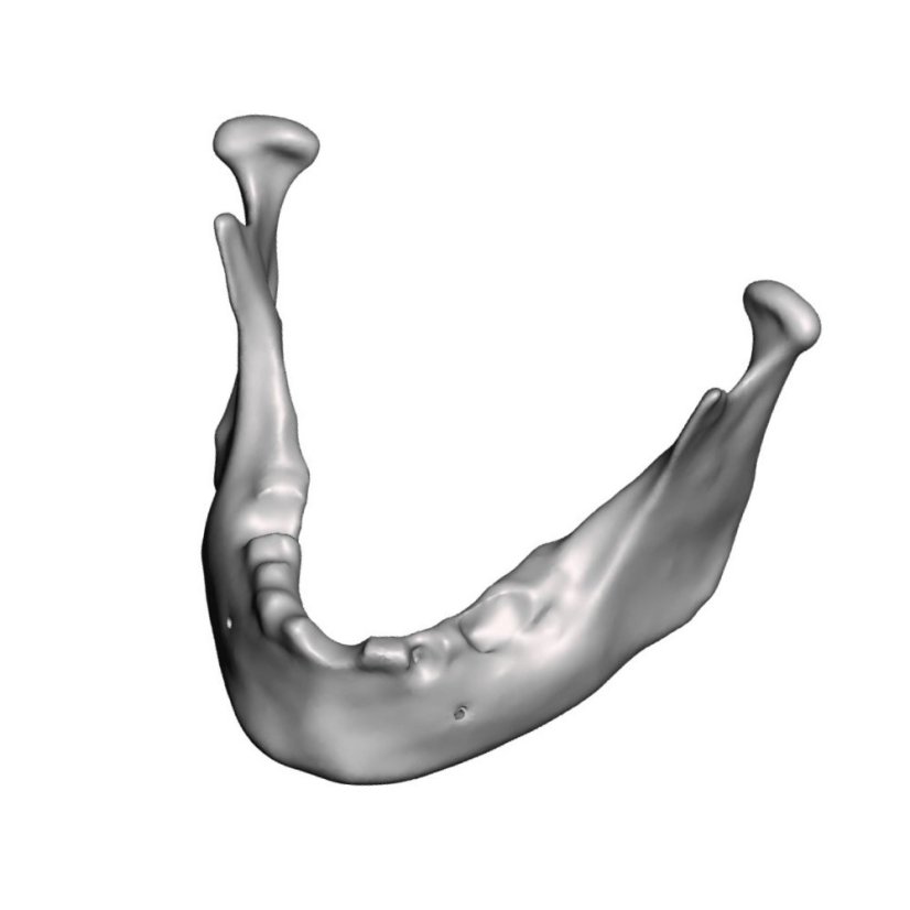 Augmentation + Implant Mandible Model