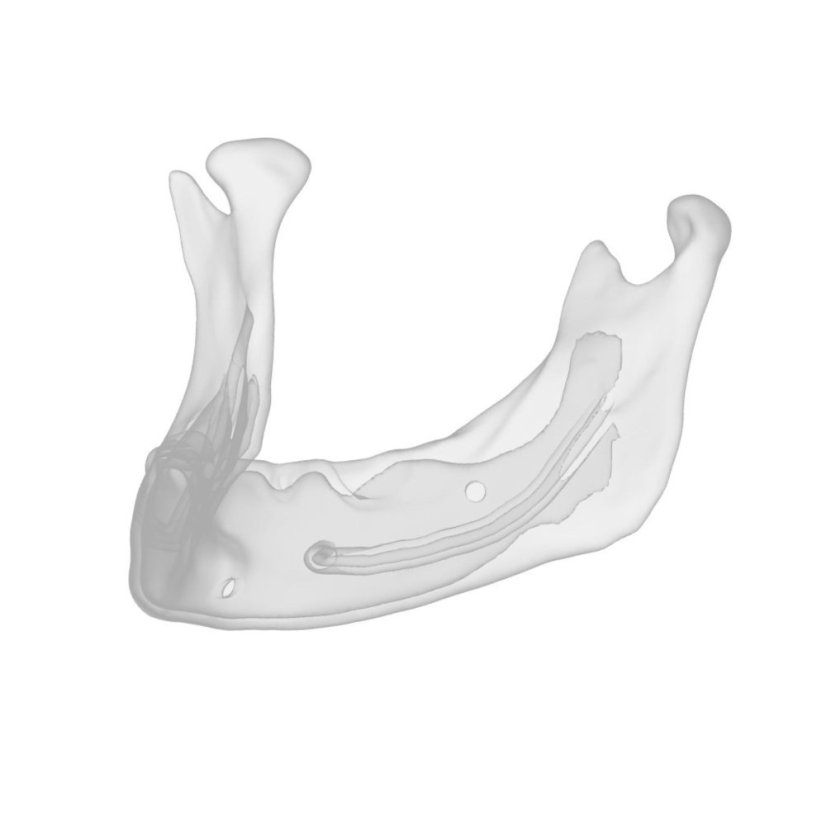 Augmentation + Implant Mandible Model