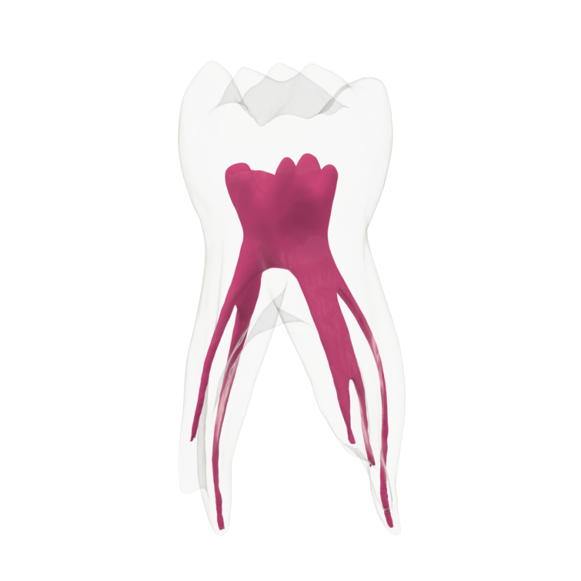 EndoTooth 84 Deciduous Lower Molar - Transparencia: Opaco, Acceso al diente: Accedido, Pulpa dental: Con pulpa