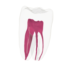 EndoTooth 36 Lower Molar (Less Complex)