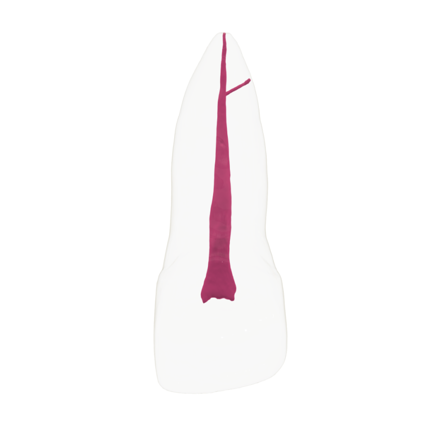 EndoTooth 11 Upper Incisor - Transparencia: Transparente, Acceso al diente: Accedido, Pulpa dental: Con pulpa