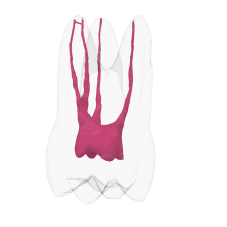 Endotooth 16 Upper Molar (Biovoxel Typodont)