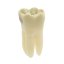 CariesTooth 46 (Biovoxel Typodont) - Caries: Mesio - Occluso - Distal