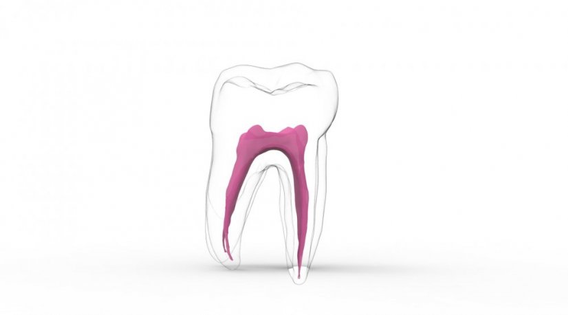 EndoTooth 37 Lower Molar (More Complex) - Acceso al diente: Intacto, no accedido, Pulpa dentaria: Con tejido pulpar