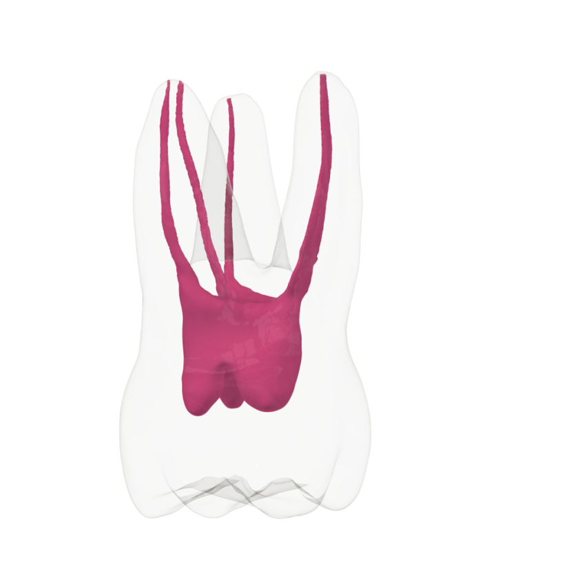EndoTooth 16 Upper Molar (Less Complex) - Priehladnosť: Nepriehladný, Trepanácia: Trepanovaný, Zubná dreň: Bez drene