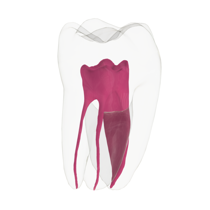 EndoTooth 36 Lower Molar (Less Complex) - Transparencia: Transparente, Acceso al diente: Intacto, no accedido