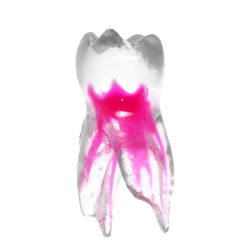 EndoTooth 84 Deciduous Lower Molar - Durchsichtigkeit: Übersichtlich, Zugriff auf den Zahn: Intakt, nicht zugegriffen, Zahnpulpa: Mit Pulpagewebe